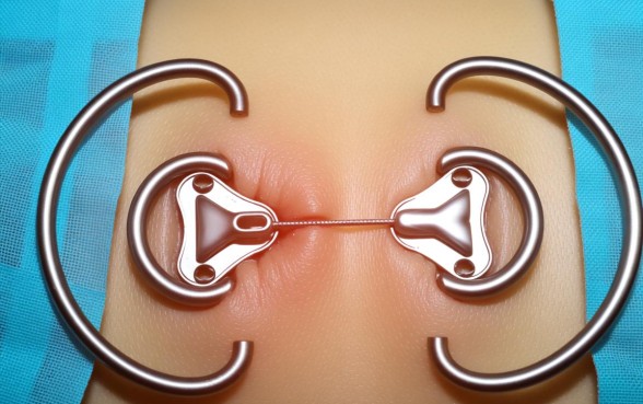 下钢板的口子一般多久不要包纱布